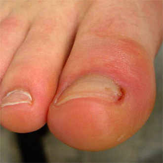 Ingroeiende nagel