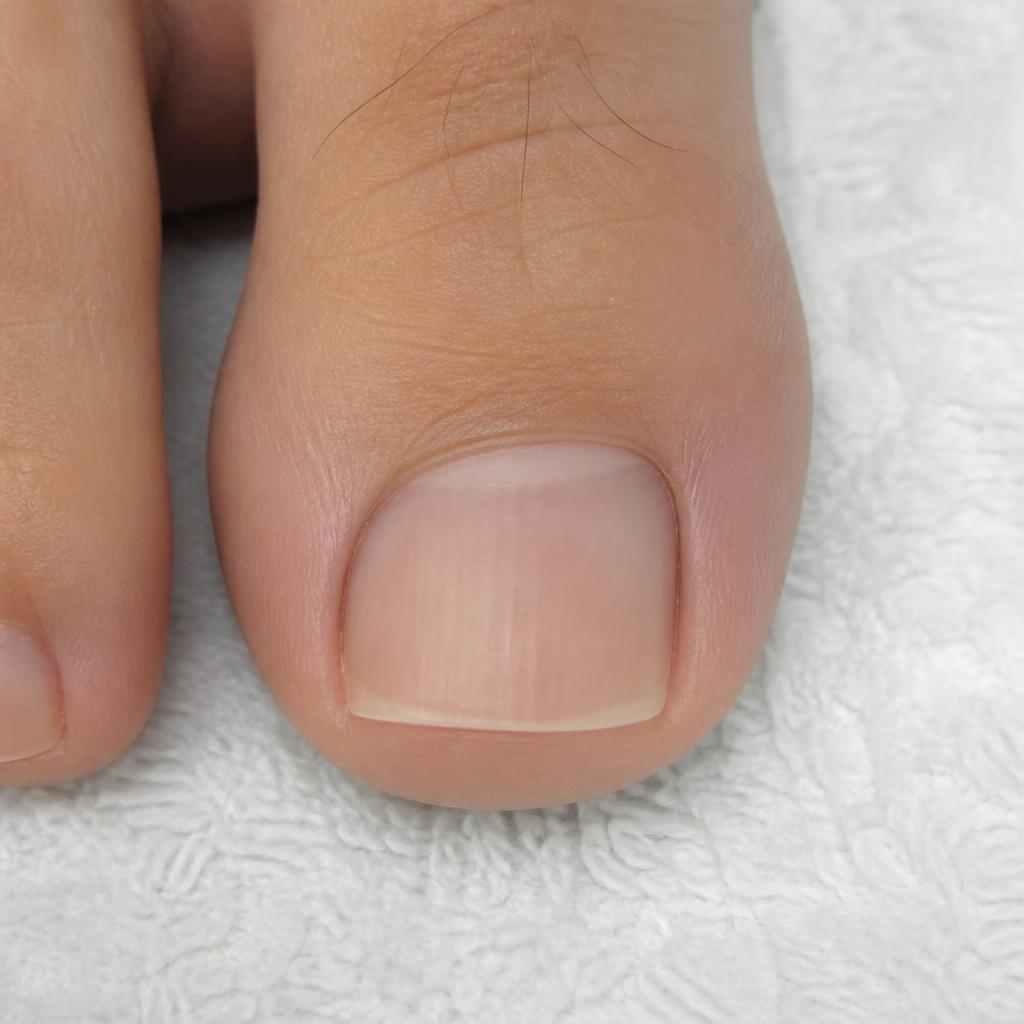 Ingroeiende nagel — na de behandeling