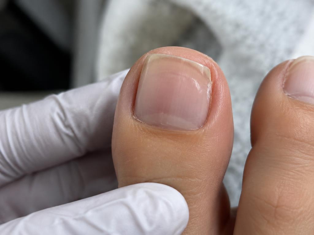Nagelreconstructie